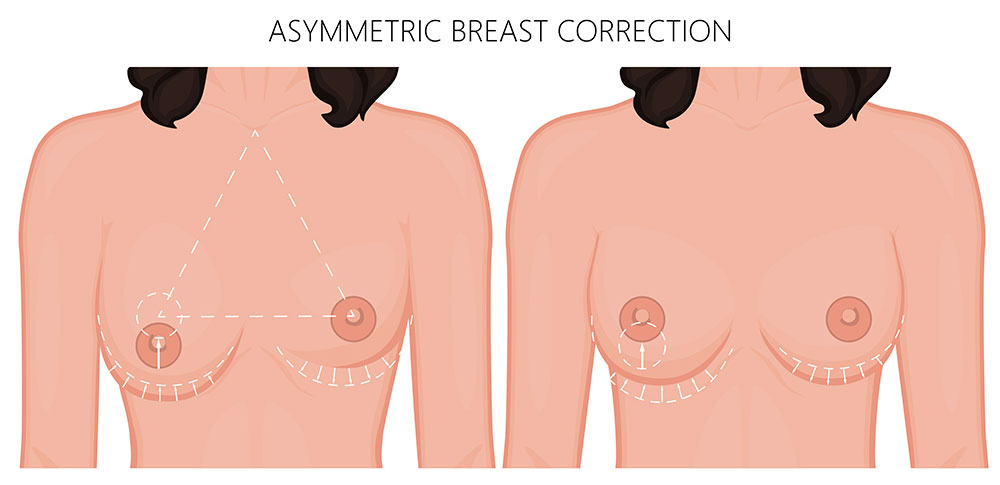 asimetria mamaria